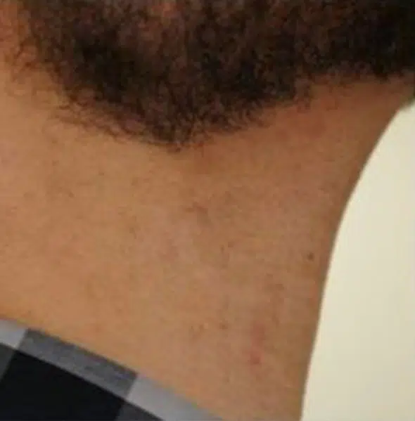 patient-5118-laser-hair-removal-after.jpg